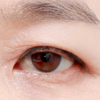 ศัลยกรรมหนังตาบน