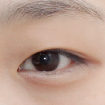 ศัลยกรรมเปิดหัวดวงตา