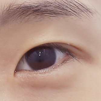 ศัลยกรรมเปิดหางตาสองแบบ