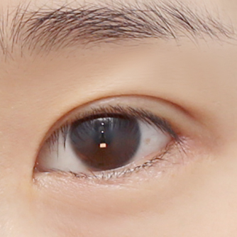 ศัลยกรรมเปิดหางตาสองแบบ