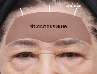 ดึงหน้าผาก (ศัลยกรรมยกคิ้ว)