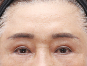 ดึงหน้าผาก (ศัลยกรรมยกคิ้ว)